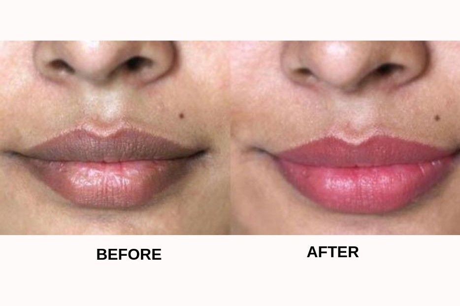 How To Lighten Dark Lips - 10 Most Effective Remedies