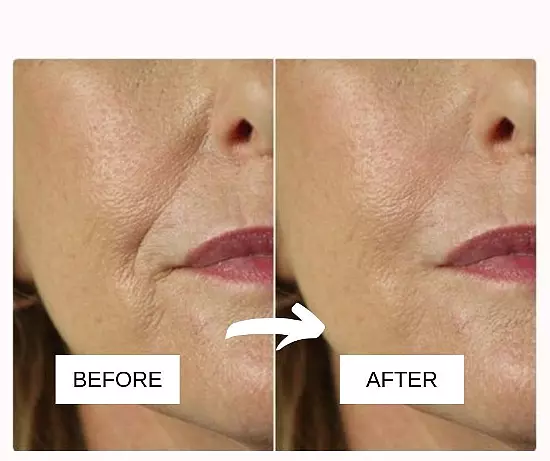 Home Remedies For Wrinkles