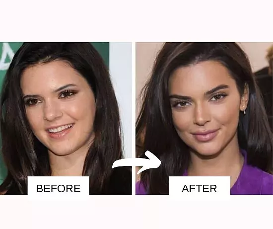 Celebrities With Lip Fillers