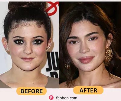 Kylie Jenner Plastic Surgery