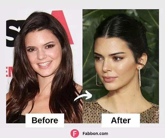 Kendall Jenner Plastic Surgery And Nose Job