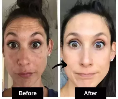 dark spots remedies