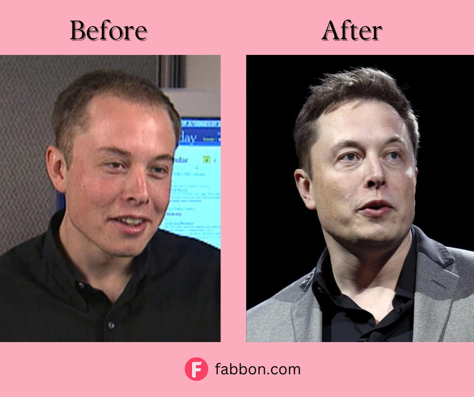 Did Elon Musk Undergo A Hair Transplant? | Fabbon