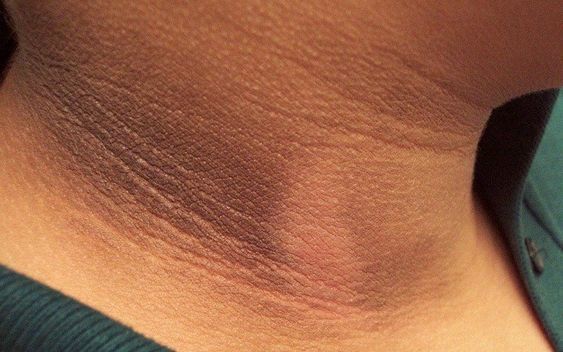 Dark Neck: Causes, Pics, 15 Proven Remedies To Remove It | Fabbon