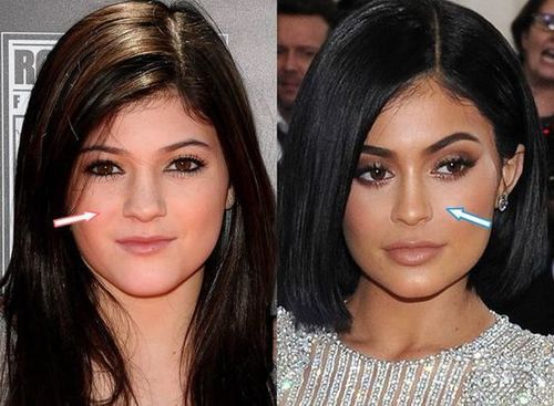 Popular Celebrity Nose Jobs With Images
