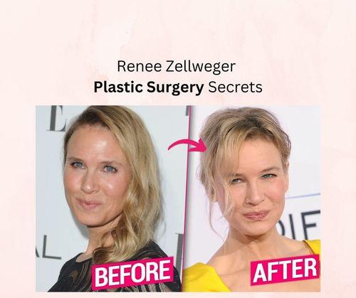Renee Zellweger Plastic Surgery