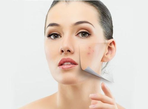 How To Get Rid Of Acne Scars