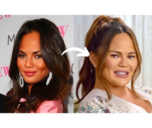 Chrissy Teigen Plastic Surgery Secrets