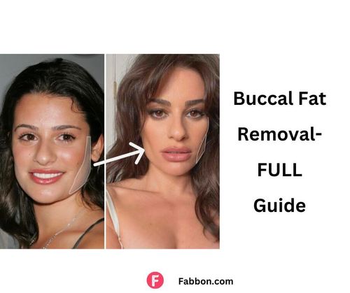 Buccal Fat Removal