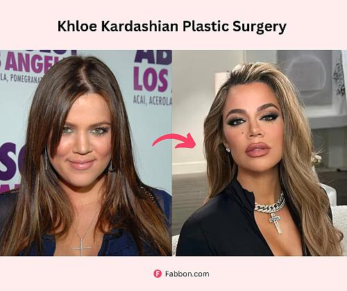 Khloe Kardashian Plastic Surgery