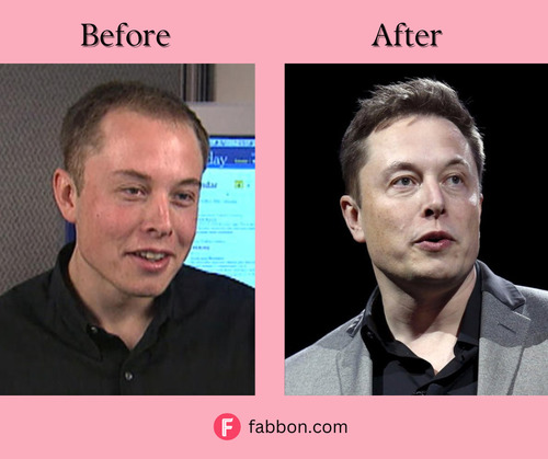 Elon Musk Hair Transplant 