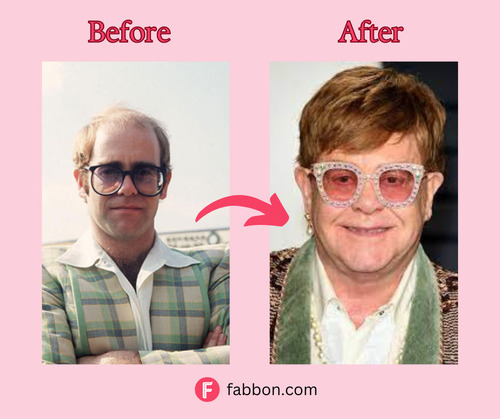 Famous Celebrities With A Hair Transplant  