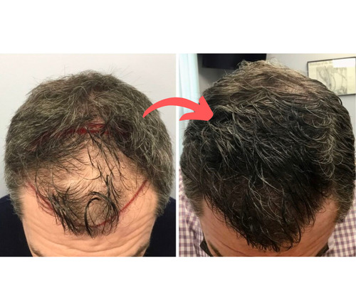 Fut Hair Transplant