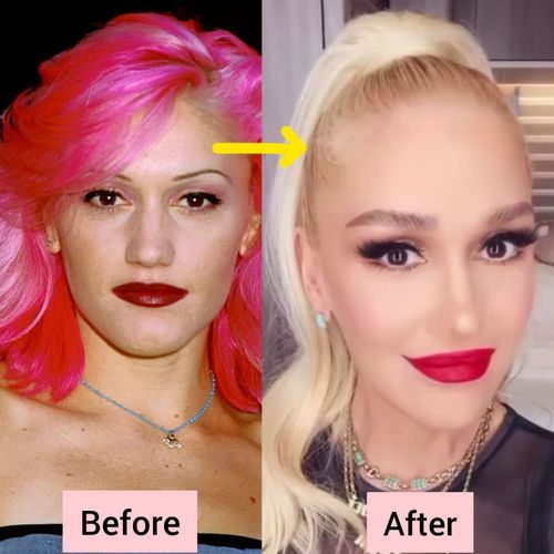 Gwen Stefani Plastic Surgery Details