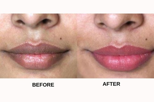  5 Proven Ways To Lighten Dark Lips