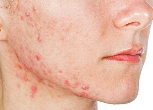 Cystic Acne: Causes, Treatment, Symptoms And Prevention 