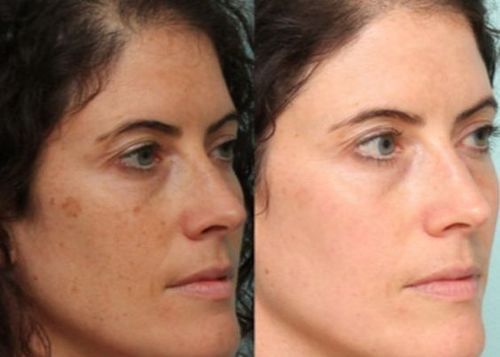 Best Natural Remedies For Dark Spots On Face