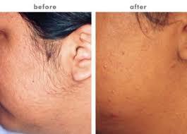 Facial Hair Removal At Home