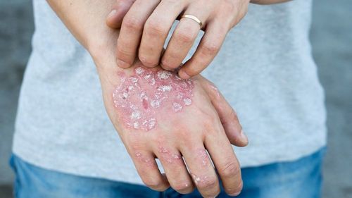 Home Remedies For Eczema