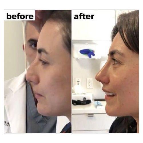 Nose Job Types, Pros And Cons 