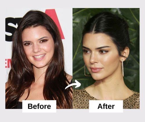 Kendall Jenner Plastic Surgery And Nose Job
