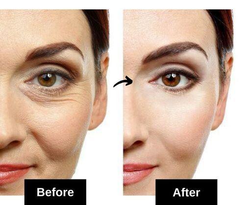 under eye wrinkles home remedies