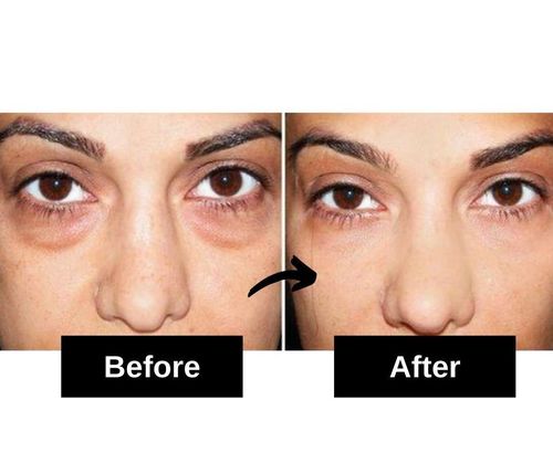 puffy eyes home remedy