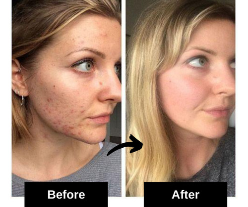 acne scars home remedy