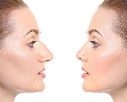 what is rhinoplasty