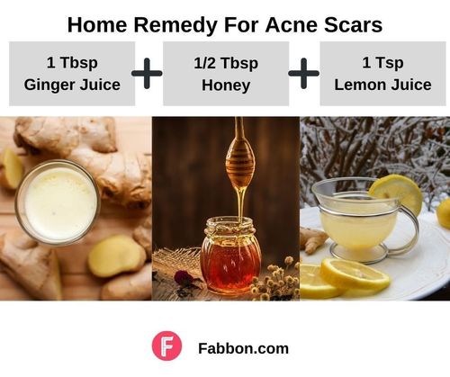5_Home_Remedies_For_Acne_Scars