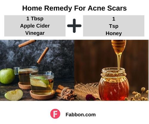 10_Home_Remedies_For_Acne_Scars