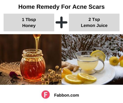 11_Home_Remedies_For_Acne_Scars