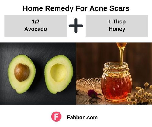 13_Home_Remedies_For_Acne_Scars