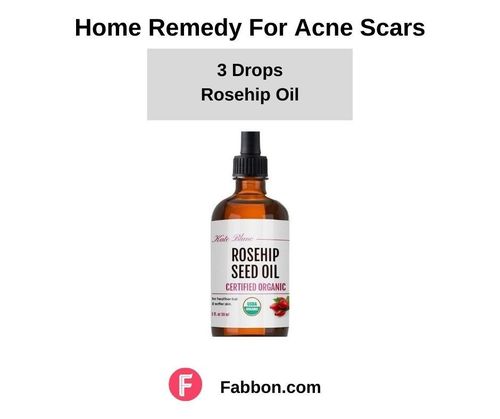 14_Home_Remedies_For_Acne_Scars