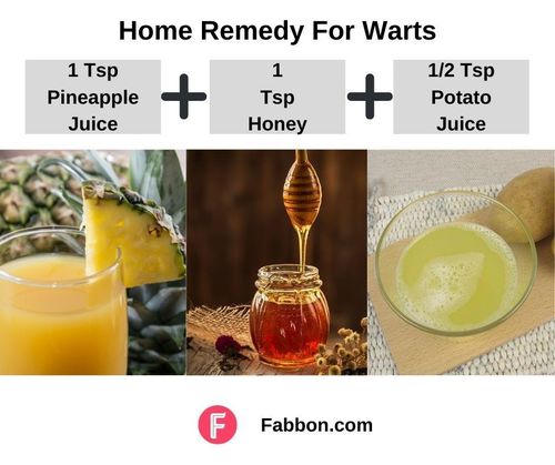 5_Home_Remedies_For_Warts