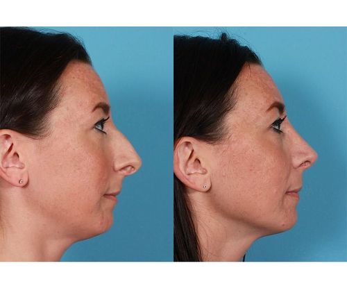 5_What_Is_Rhinoplasty