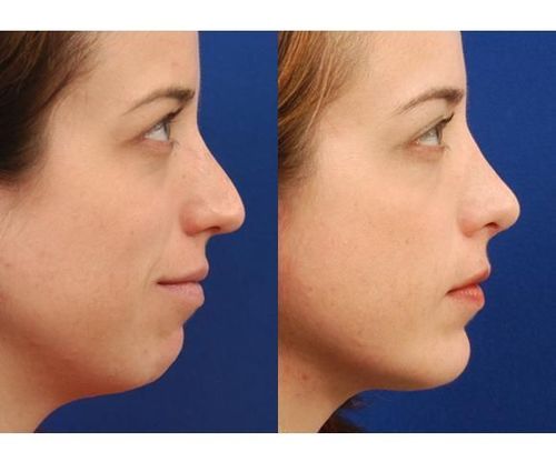 18_What_Is_Rhinoplasty