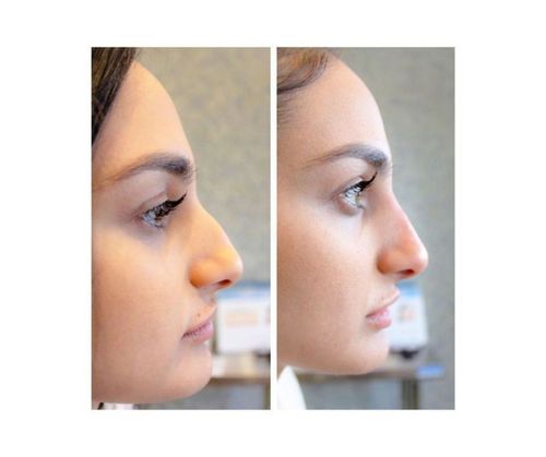 16_What_Is_Rhinoplasty