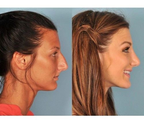 17_What_Is_Rhinoplasty