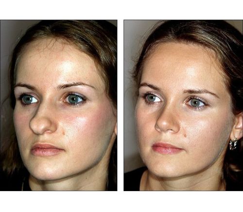 6_What_Is_Rhinoplasty