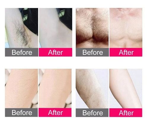 4_Laser_Hair_Removal