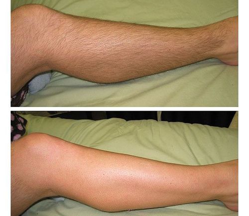 8_Laser_Hair_Removal