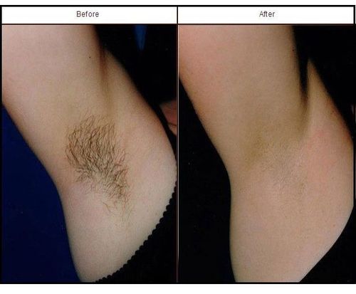 10_Laser_Hair_Removal