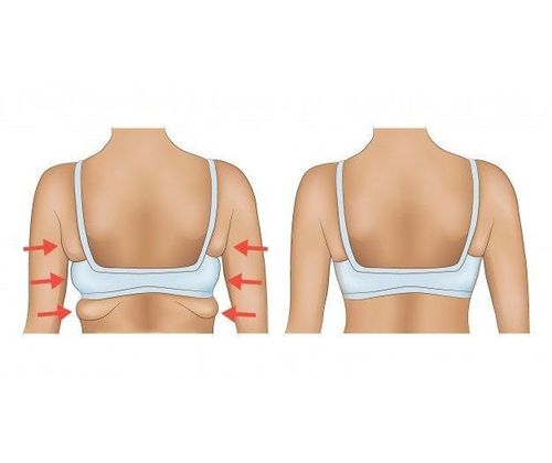 Troubled by your armpit fat when you wear your favourite sports bra or  sleeveless blouse? Here's how you can reduce your bra bulge effectively -  and it's not exercise