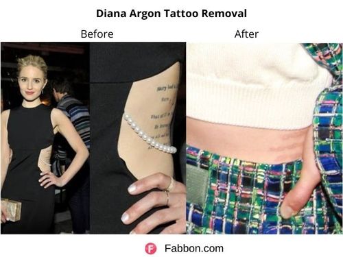 Diana-Argon-tattoo-removal