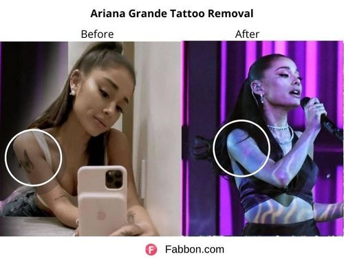 Ariana-Grande-tattoo-removal