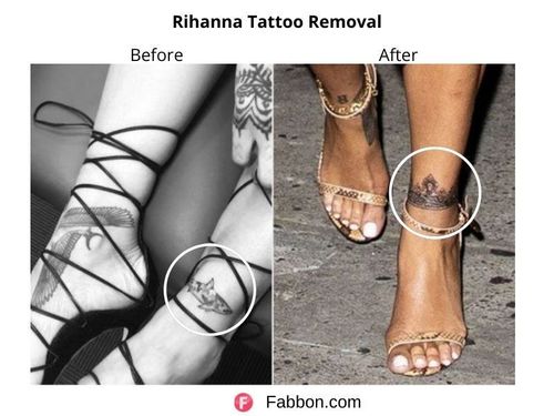 Rihanna-tattoo-removal