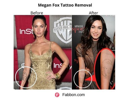 Megan-fox-tattoo-removal