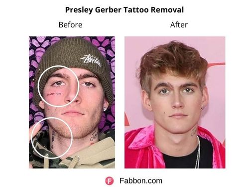 Presley-Gerber-tattoo-removal