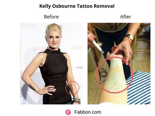 Kelly-Osbourne-Tattoo-Removal 